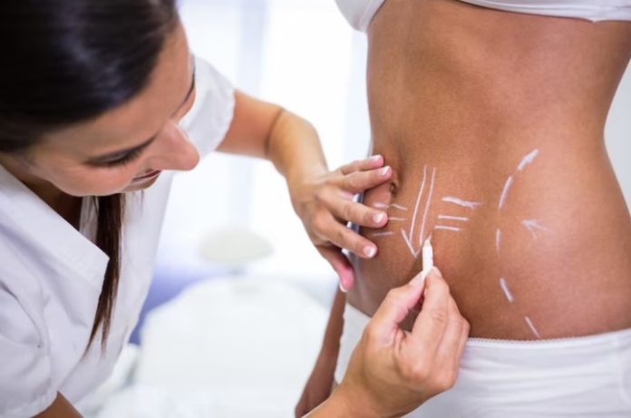 Coolsculpting